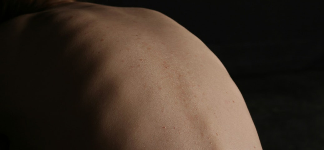 Close‑up of a human back in dim light; symbolic image for the topic best sleeping position for acute lower‑back pain